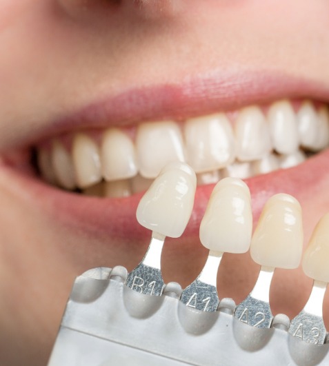 Smile Design, Veneers